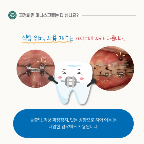 1월_교정_미니스크류_3.png