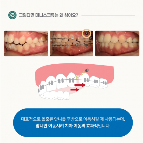 1월_교정_미니스크류_5.png