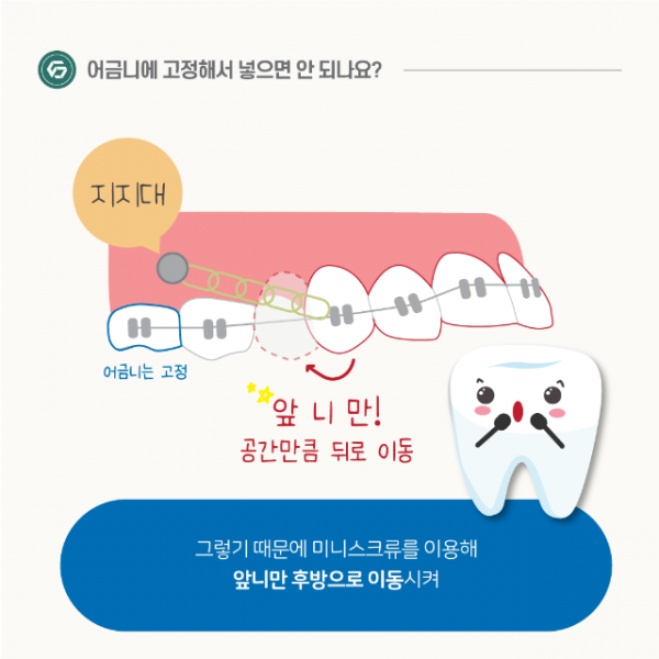 1월_교정_미니스크류_8.png