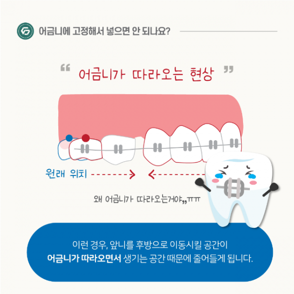 1월_교정_미니스크류_7.png