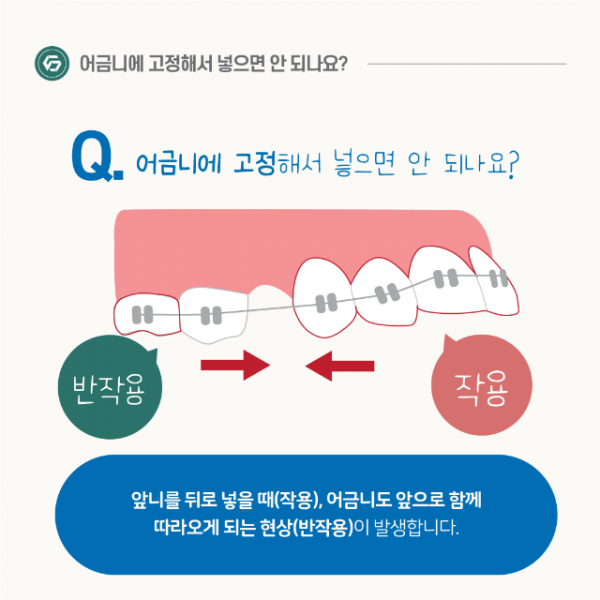 1월_교정_미니스크류_6.png