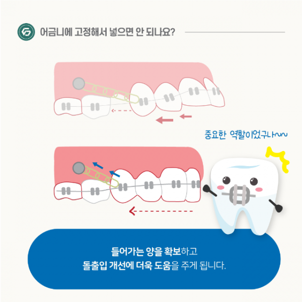 1월_교정_미니스크류_9.png