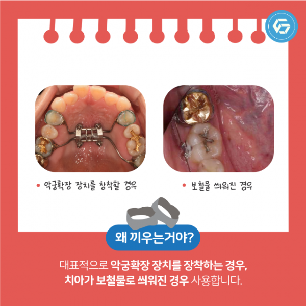 5월_교정_세퍼레이션링_4.png