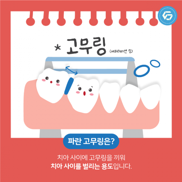 5월_교정_세퍼레이션링_2.png