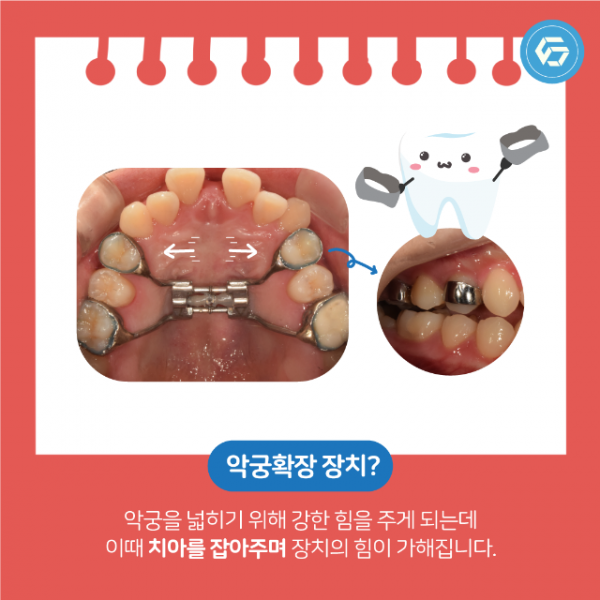 5월_교정_세퍼레이션링_5.png