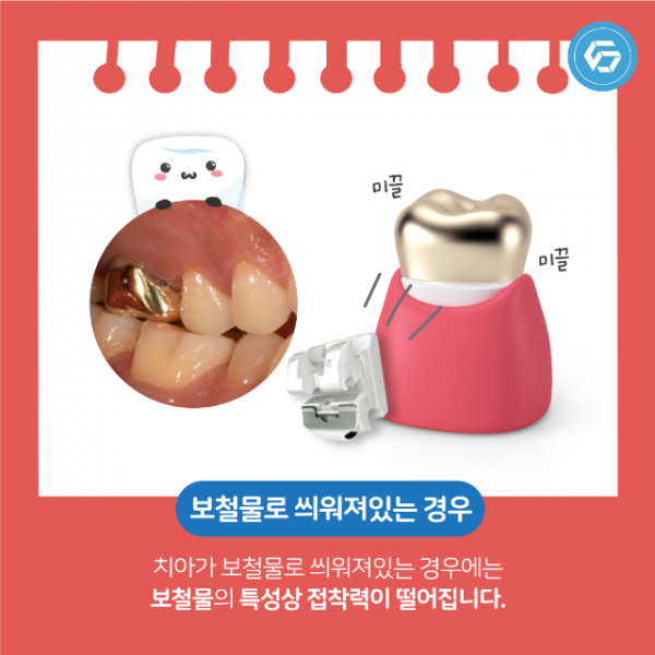 5월_교정_세퍼레이션링_6.png