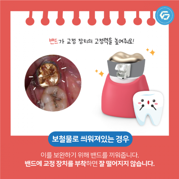 5월_교정_세퍼레이션링_7.png