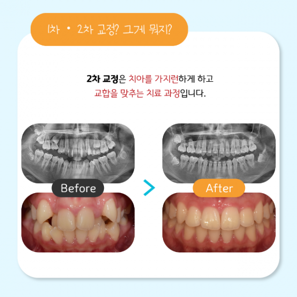 6월_소아교정_3.png