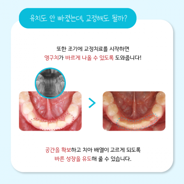 6월_소아교정_6.png