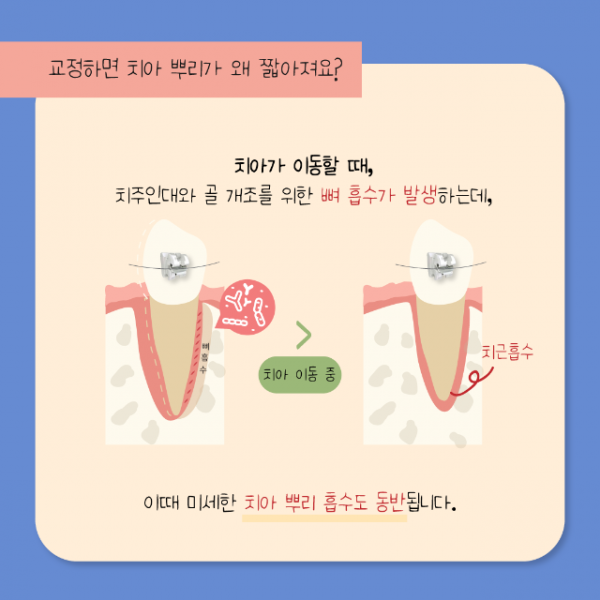 7월_교정_치근흡수_4.png