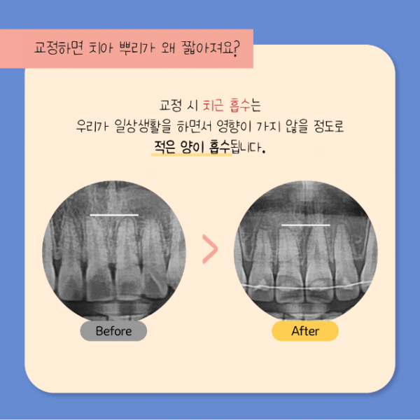 7월_교정_치근흡수_5.png