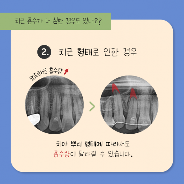 7월_교정_치근흡수_9.png