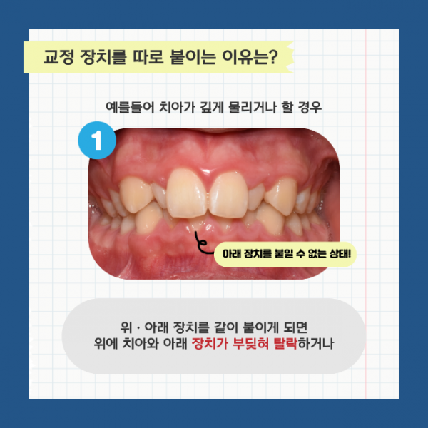 교정장치_4.png